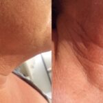 Cryo Double Chin Carmen BA 3 sessions