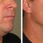 Cryo Double Chin Jacques BA 3 sessions