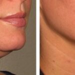 Cryo double chin 5 sessions