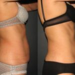 CryoSlimming Abdomen Samantha BA 3 sessions