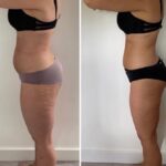 Samantha side 8 sessions slimming 8 cellulite